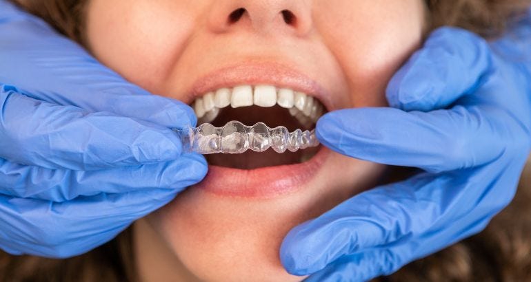 Crafting Customized Invisalign Aligners: A Step-by-Step Process