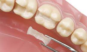 Dental Fillings in Coweta, OK: A Closer Look at Restorative Dentistry