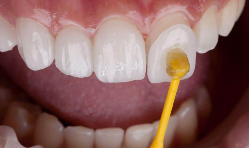 Dental Fillings in Coweta, OK: Restoring Teeth for a Healthy Smile