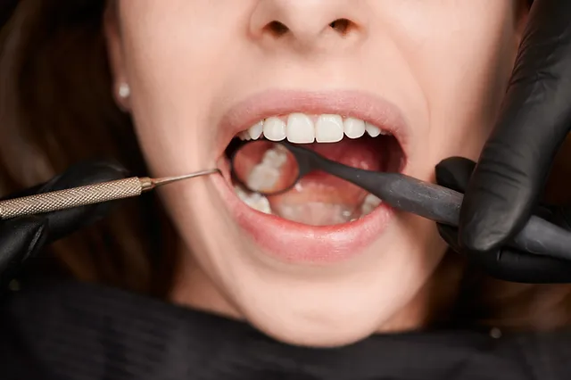 How Often Should You Visit a Dentist