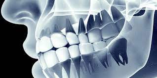 The Procedure of Dental X-Rays
