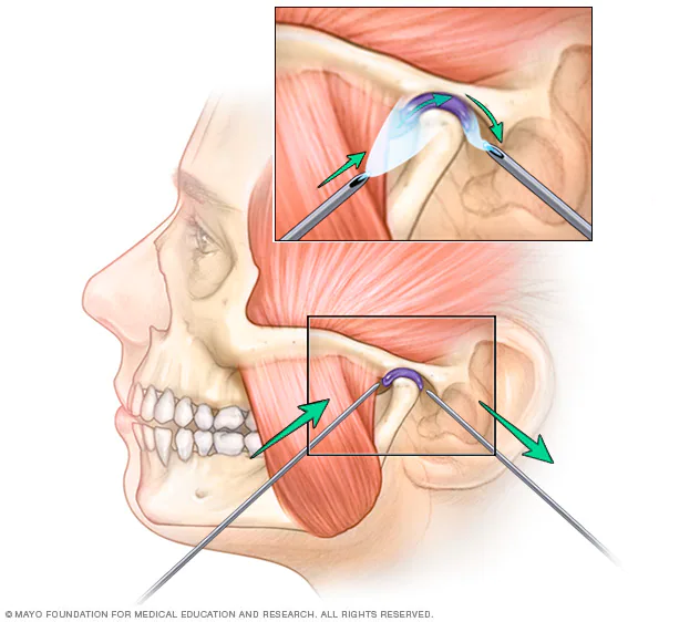 Therapies for Treating TMJ Disorders