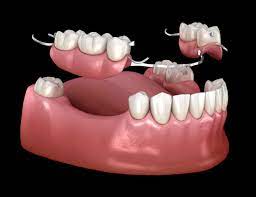Before You Smile: What to Consider Before Getting Partial Dentures