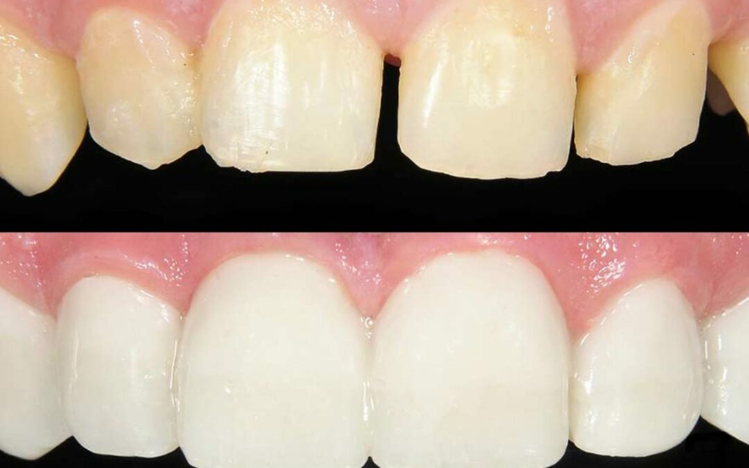 Disorders Treated by Tooth Bonding