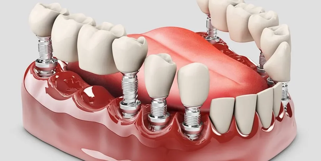 Exploring Fixed Dentures: A Stable Solution for Tooth Replacement