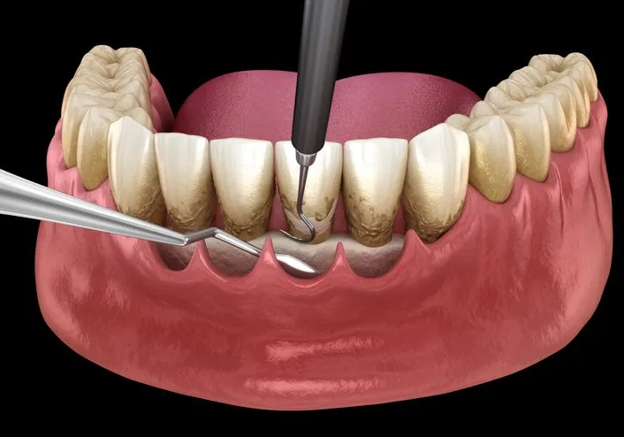 Periodontal Maintenance - Everything Included in It