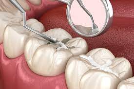 The Necessity of Dental Sealants