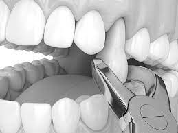 Understanding Multiple Dental Extractions