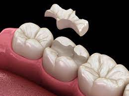 Unlocking the Benefits of Dental Inlays and Onlays