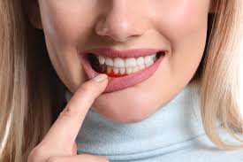  When Periodontal Treatment is Necessary