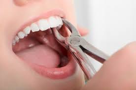 When Tooth Extraction Becomes Necessary