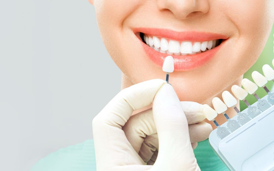 Choosing Dental Veneers Wisely