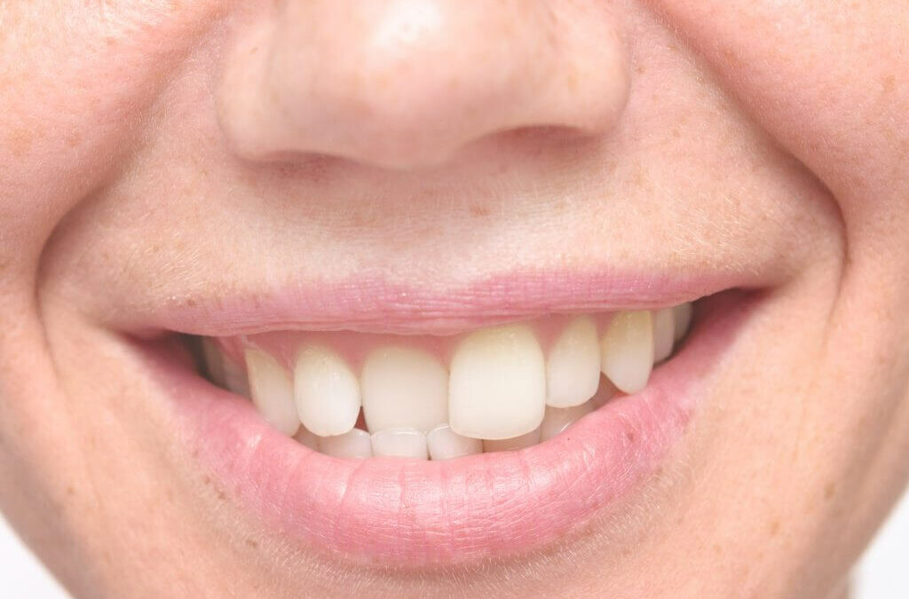 Choosing the Best Crooked Tooth Treatment