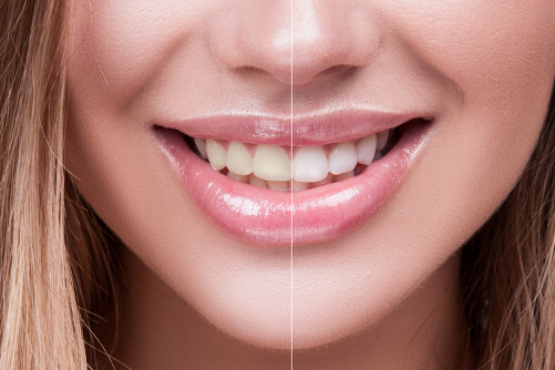 Enhancing Smiles with Dental Veneers