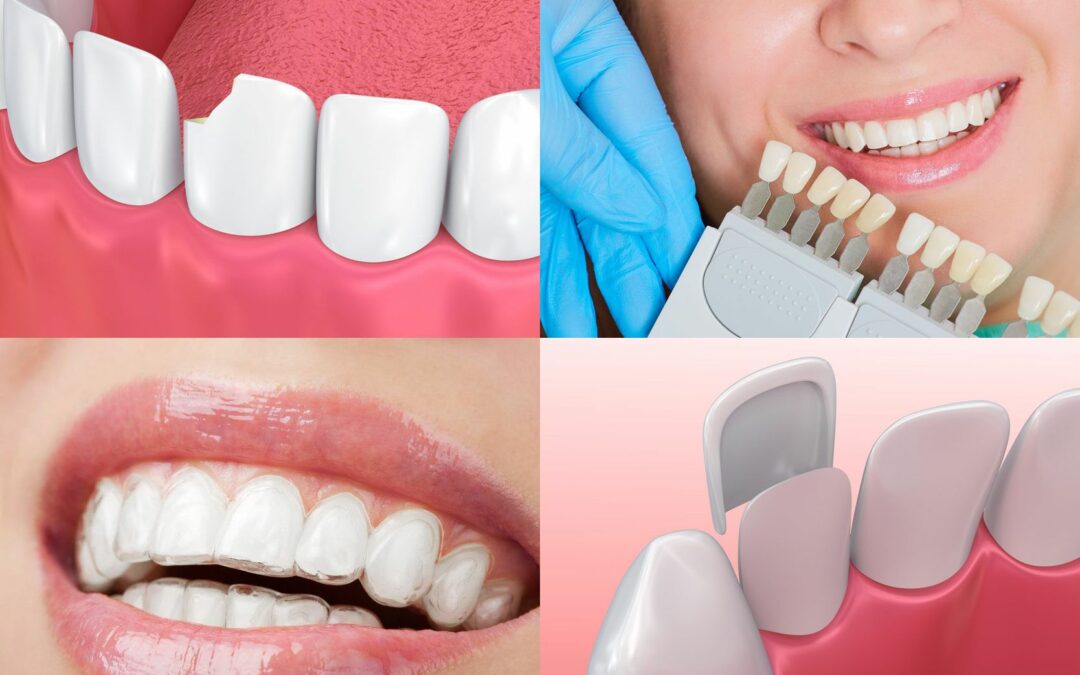 Enhancing Your Smile: Key Considerations for Smile Makeovers