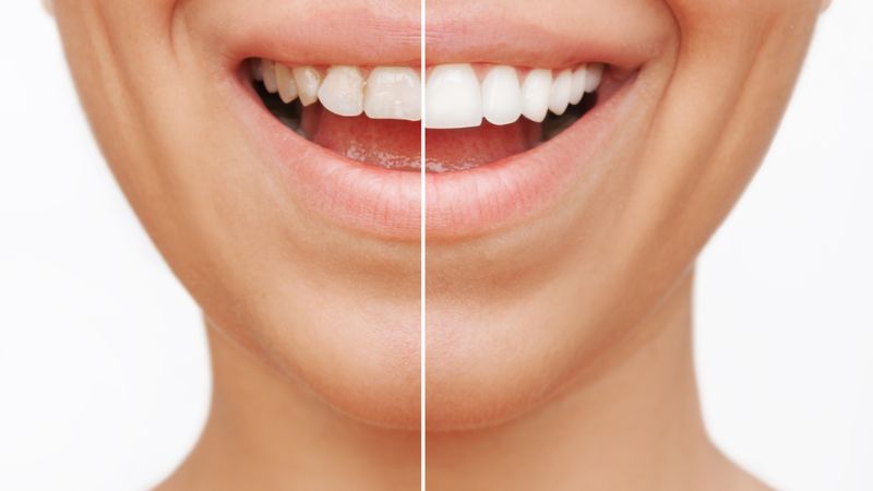 Enhancing Your Smile with Teeth Whitening