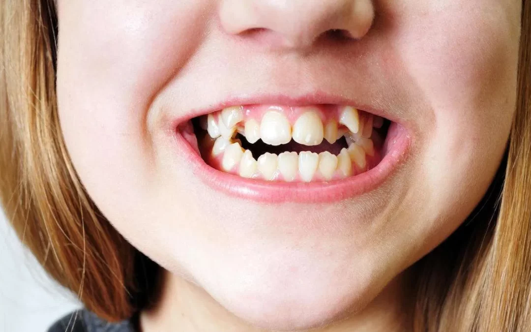 Factors to Consider for Crooked Teeth Treatment