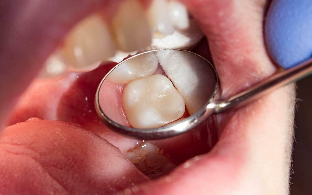 Knowing When to Consider Root Canal Treatment