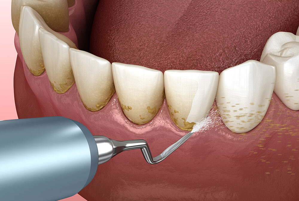 Recognizing the Need for Periodontal Therapy