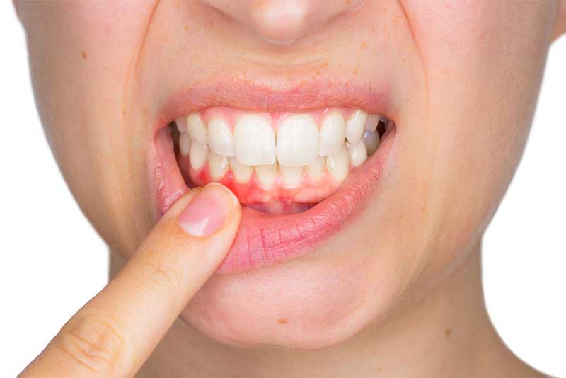 Recognizing the Signs You Need Periodontal Disease Treatment