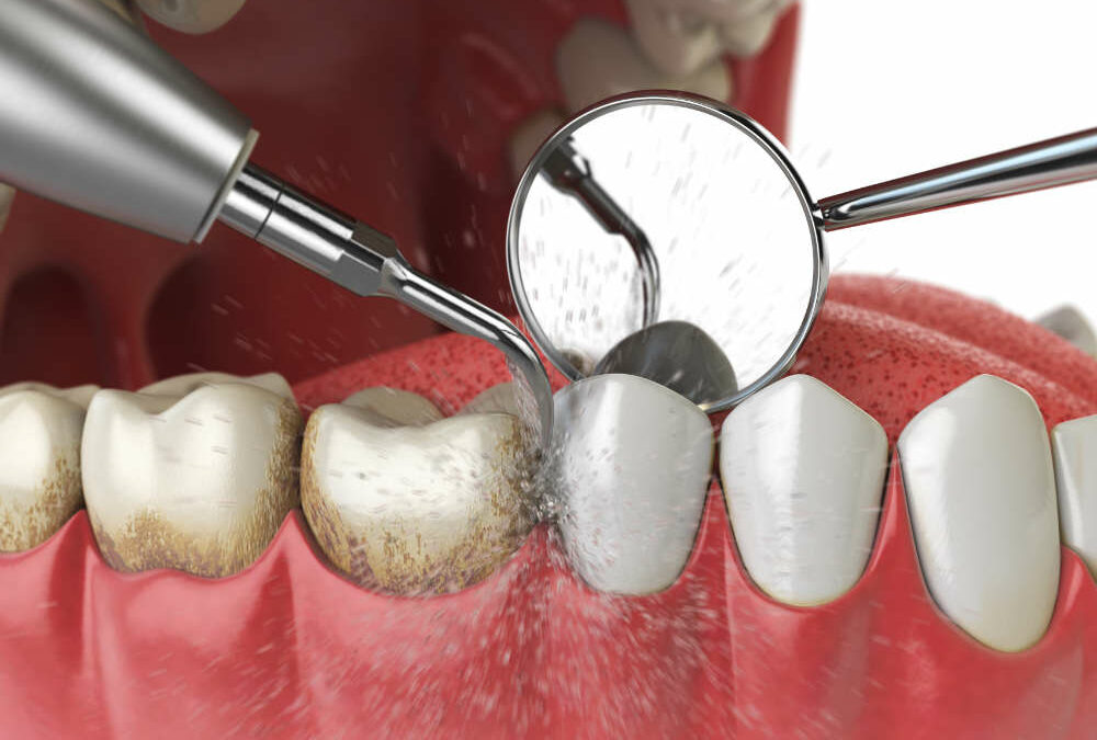 The Significance of Deep Cleaning in Periodontal Disease Treatment