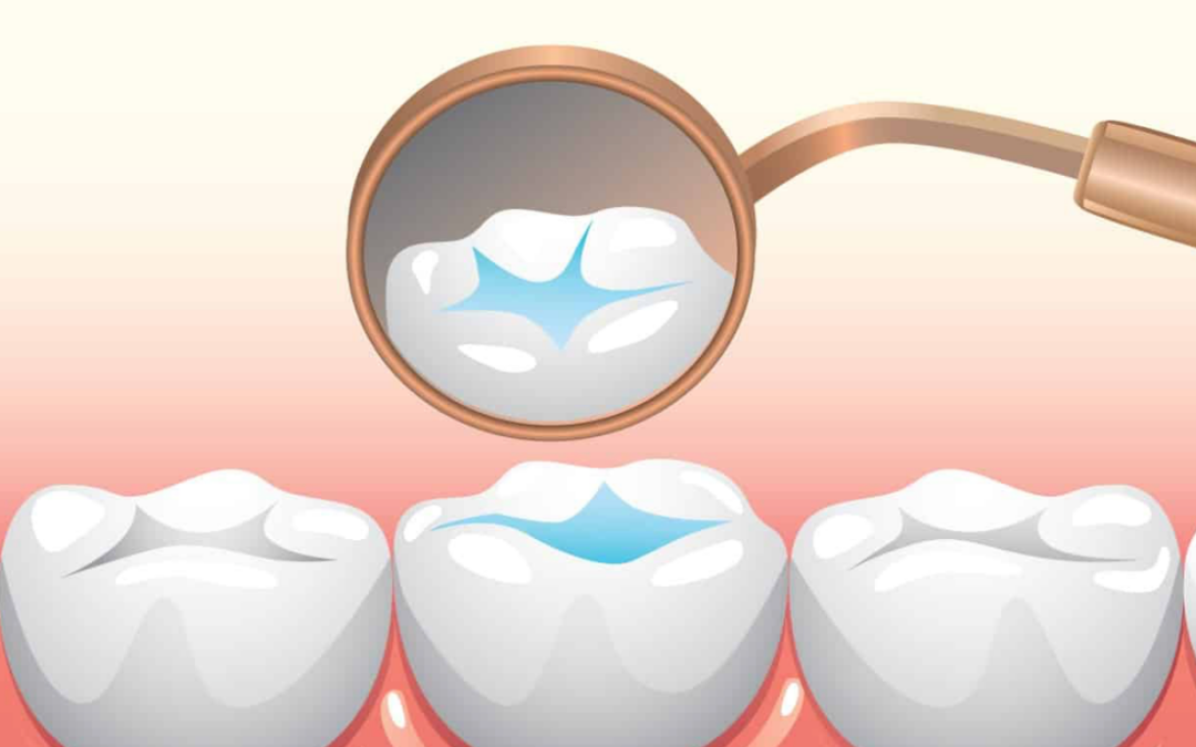 Understanding Dental Sealants