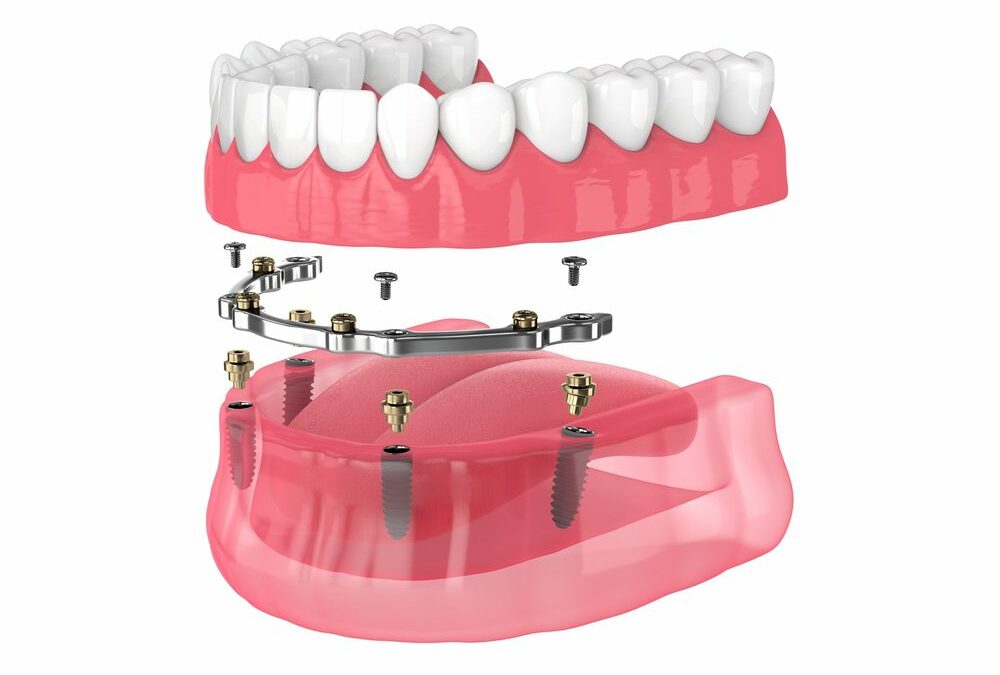 Understanding Fixed Dentures: Are They Permanent?