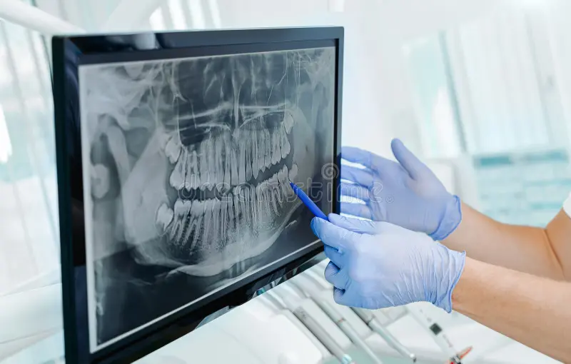 Unveiling Dental X-Rays: Insights and Information